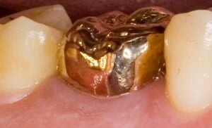 Gold molar.jpg
